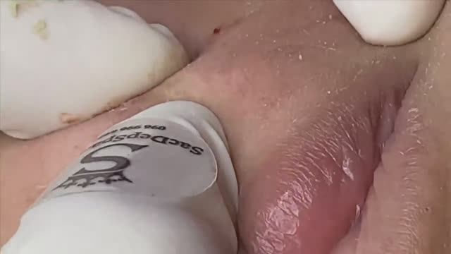 Лечение гормональных прыщей (акне) - SDS#148 смотреть онлайн