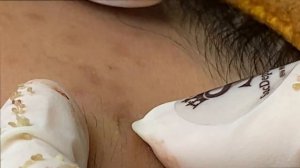 Внутренние прыщи и подкожные сальные пробки - SDS#150