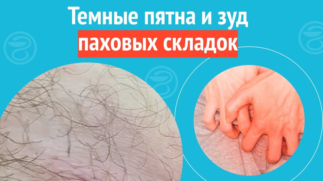🙄 Темные пятна и зуд паховых складок. Клинический случай №1527 смотреть онлайн