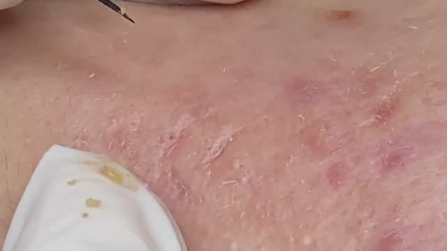 Удаление обыкновенных прыщей - SDS#156 смотреть онлайн