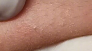 Чистка лица от угрей и акне. Выдавливание прыщей. Удаление черных точек и комедонов