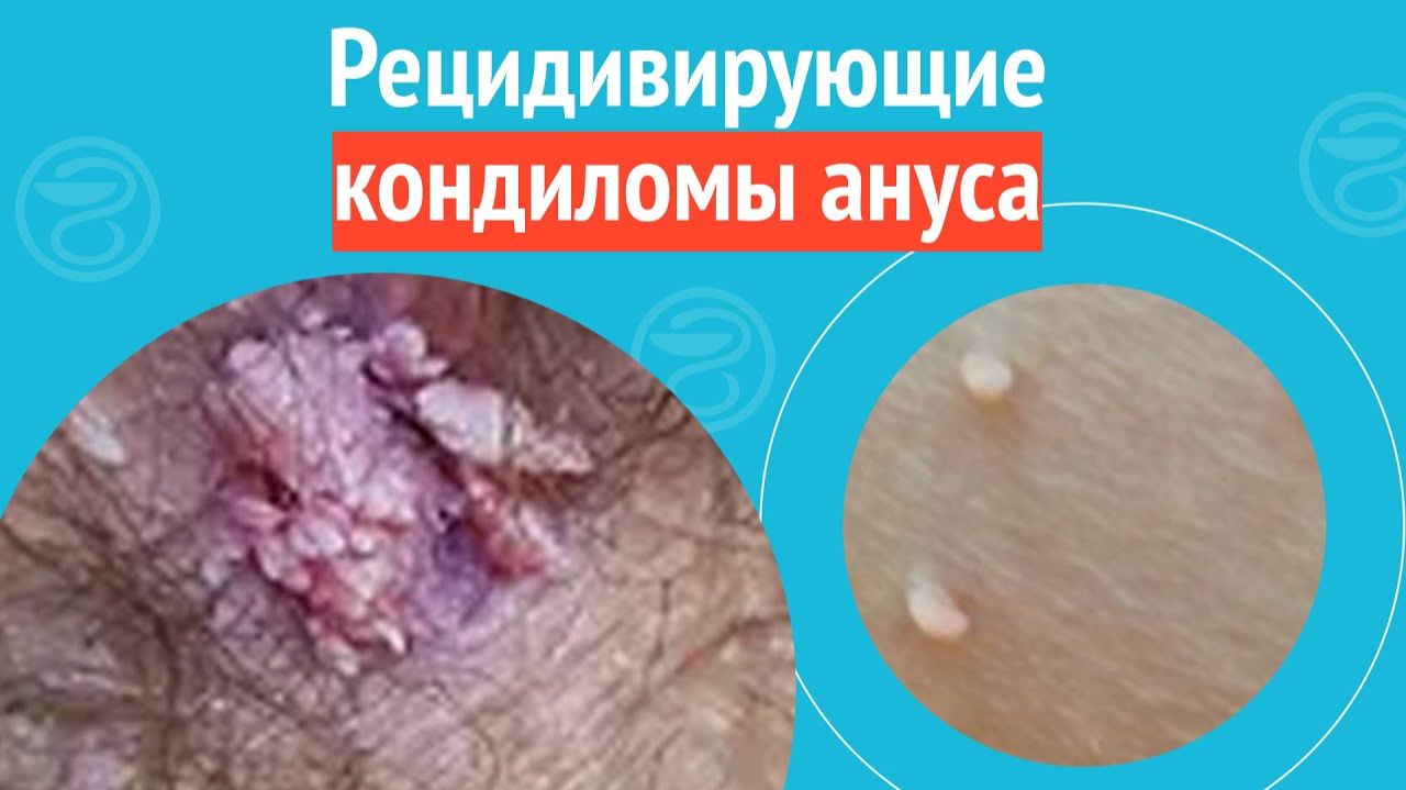 🥺Рецидивирующие кондиломы ануса. Клинический случай №1705 смотреть онлайн