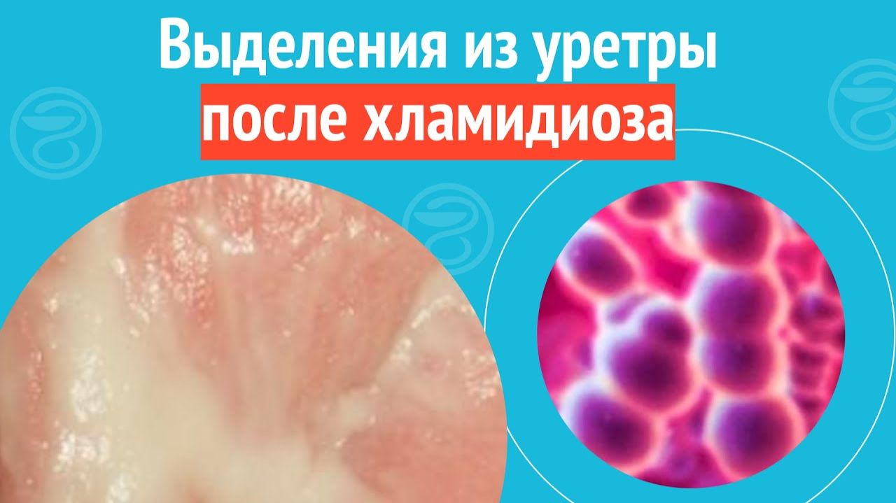 😧 Выделения из уретры после хламидиоза. Клинический случай №1526 смотреть онлайн