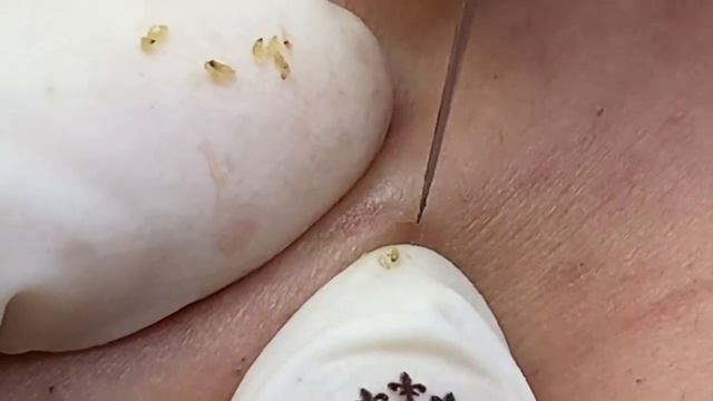 Избавление от чёрных точек - SDS#151 смотреть онлайн