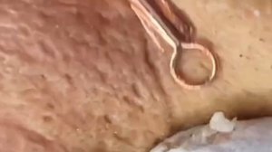 Чистка лица от угрей и акне. Выдавливание прыщей. Удаление черных точек и комедонов