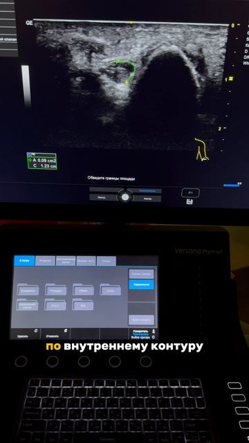 УЗИ локтевого нерва в кубитальном туннеле pain managment лечениеболи УЗИ навигация узинервов