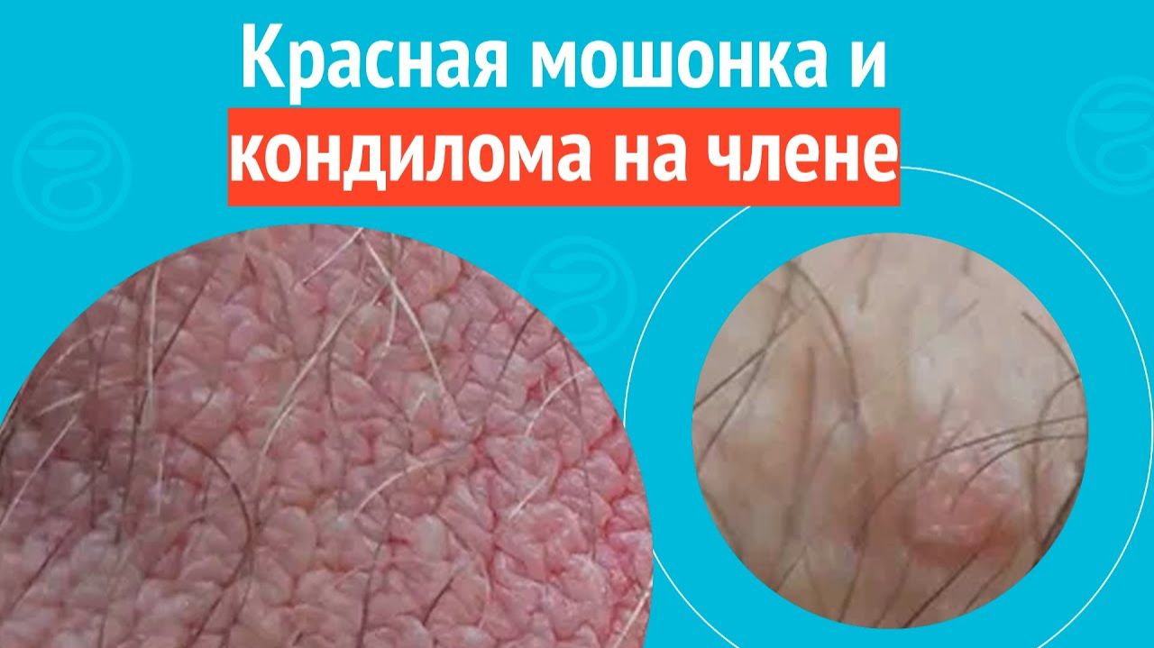 😡 Красная мошонка и кондилома на члене. Клинический случай №1532 смотреть онлайн