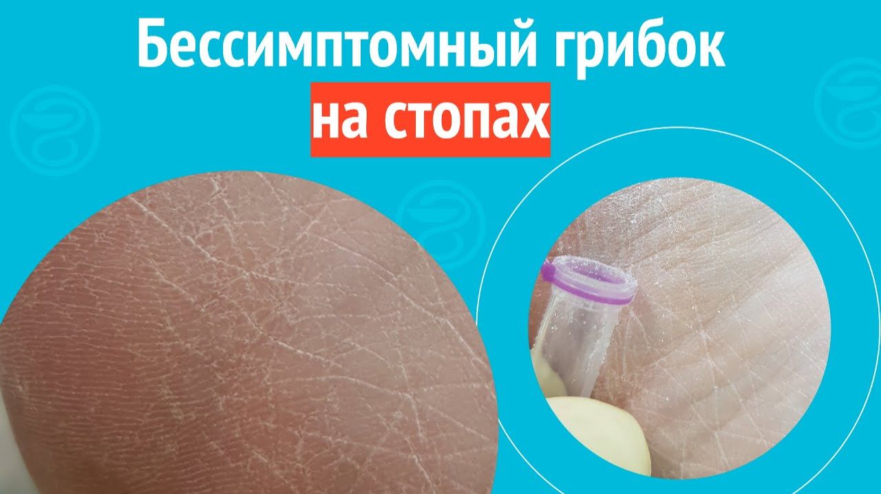 🍄 Бессимптомный грибок на стопах. Клинический случай №1529 смотреть онлайн