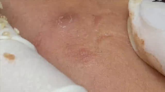 Скрытые (закрытые) комедоны и глубокие прыщи - SDS#138 смотреть онлайн