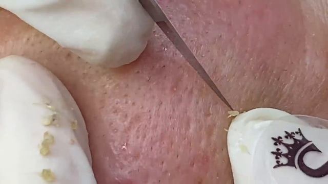 Удаление акне у мужчины - SDS#153 смотреть онлайн