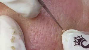 Удаление акне у мужчины - SDS#153