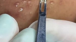 Чистка лица от угрей и акне. Выдавливание прыщей. Удаление черных точек и комедонов