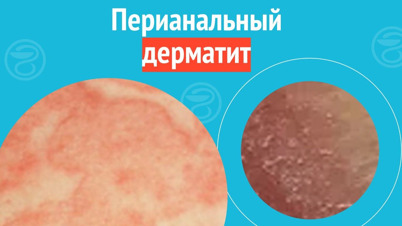 😦 Перианальный дерматит. Клинический случай №1701 смотреть онлайн