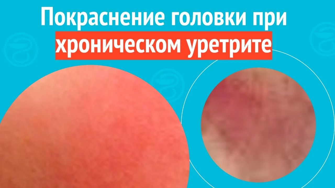 😡 Покраснение головки при хроническом уретрите. Клинический случай № 1733 смотреть онлайн