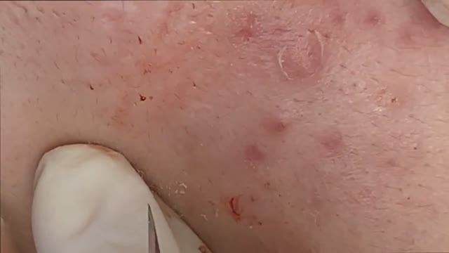 Удаление стойких угрей на щеках SDS#155 смотреть онлайн