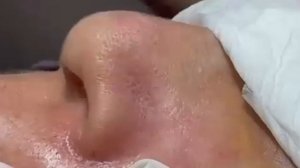 Чистка лица от угрей и акне. Выдавливание прыщей. Удаление черных точек и комедонов