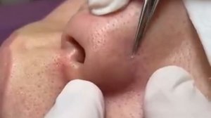 Чистка лица от угрей и акне. Выдавливание прыщей. Удаление черных точек и комедонов