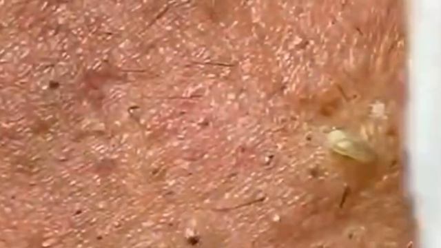 Чистка лица от угрей и акне. Выдавливание прыщей. Удаление черных точек и комедонов смотреть онлайн