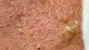 Чистка лица от угрей и акне. Выдавливание прыщей. Удаление черных точек и комедонов