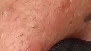 Чистка лица от угрей и акне. Выдавливание прыщей. Удаление черных точек и комедонов