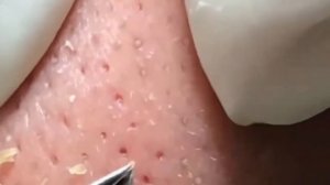 Чистка лица от угрей и акне. Выдавливание прыщей. Удаление черных точек и комедонов