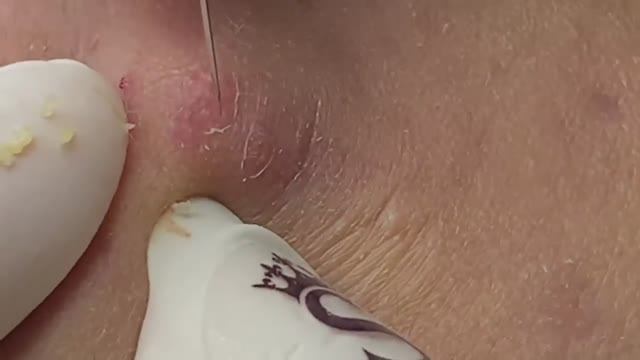 Глубокие закрытые комедоны (подкожные воспаления) - SDS#154 смотреть онлайн