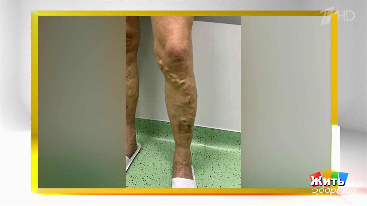 Варикоз: зима - твой союзник? Жить здорово! Фрагмент выпуска от 27.01.2026 смотреть онлайн