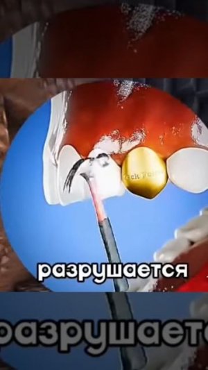 плюсы и минусы золотова зуба