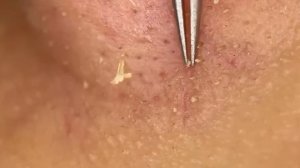 Чистка лица от угрей и акне. Выдавливание прыщей. Удаление черных точек и комедонов