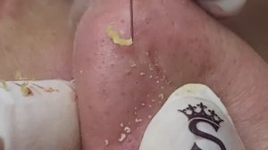 Уродливые прыщи, акне, угри и чёрные точки на носу - SDS#149