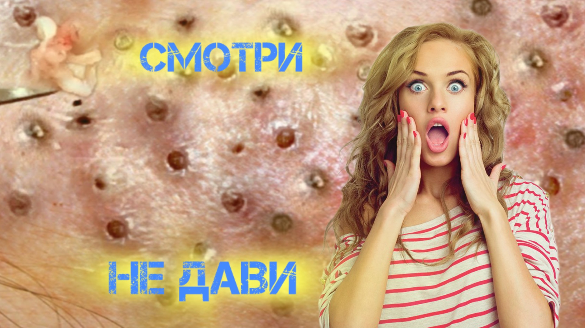 Крупные проблемы . Онлайн выдавливание ОЧЕНЬ СОЧНЫХ ПРЫЩЕЙ. Угри , акне, жировики и комедоны смотреть онлайн