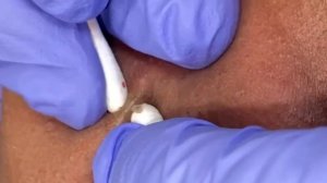 Чистка лица от угрей и акне. Выдавливание прыщей. Удаление черных точек и комедонов