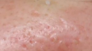 Чистка лица от угрей и акне. Выдавливание прыщей. Удаление черных точек и комедонов