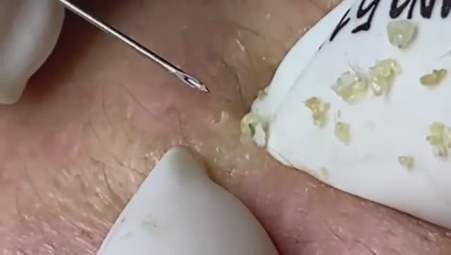 Relax Acne 031 • АСМР • Loan Nguyen collection смотреть онлайн