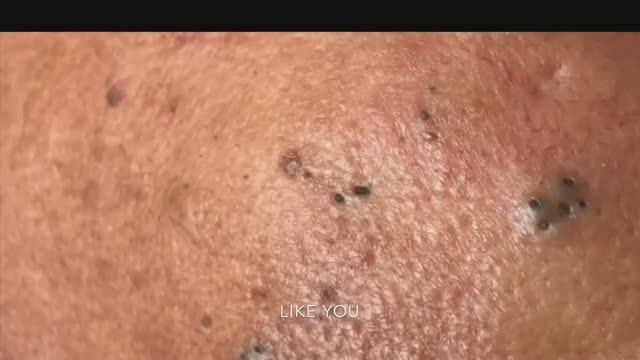 Очищение кожи от акне. Расслабляющее видео. смотреть онлайн