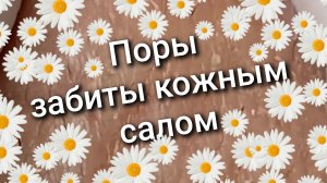 Поры забиты кожным салом 9