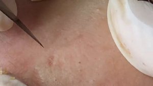 Очистка от подкожных прыщей - SDS#167