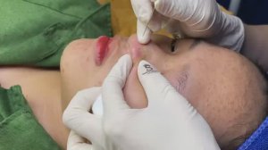 Акне, которое оставляет шрамы - SDS#161