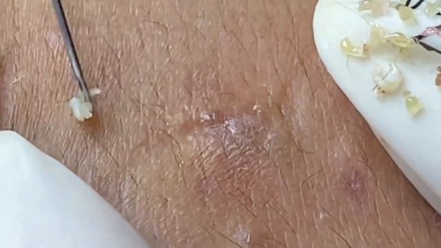 Выдавливание прыщей, угрей, черных точек и камедонов #78 смотреть онлайн