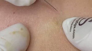 Глубокие чёрные точки (закрытые комедоны) - SDS#165