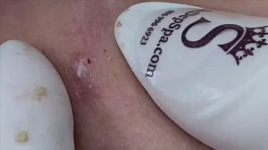 Быстрое удаление прыщей и чёрных точек. - SDS#164