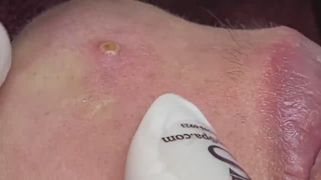 ASMR | Удаление внутренних кистозных прыщей.- SDS#160 смотреть онлайн