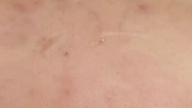 Прыщи и акне на лбу. Экстракция - SDS#157 смотреть онлайн