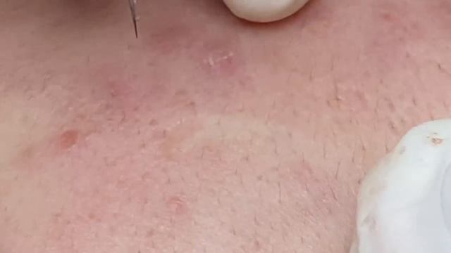 Удаление скрытых прыщей и акне - SDS#163 смотреть онлайн