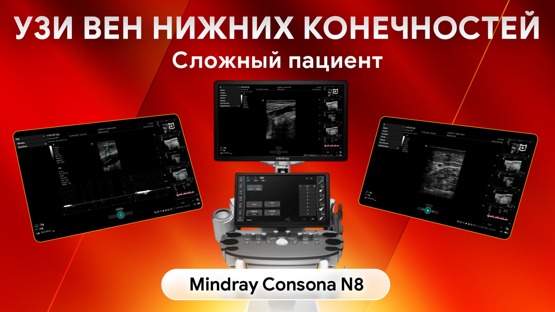 УЗИ вен нижних конечностей при ожирении: возможности Mindray Consona N8 смотреть онлайн