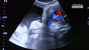 Заксобрание Иркутской области утвердило штрафы за склонение к аборту