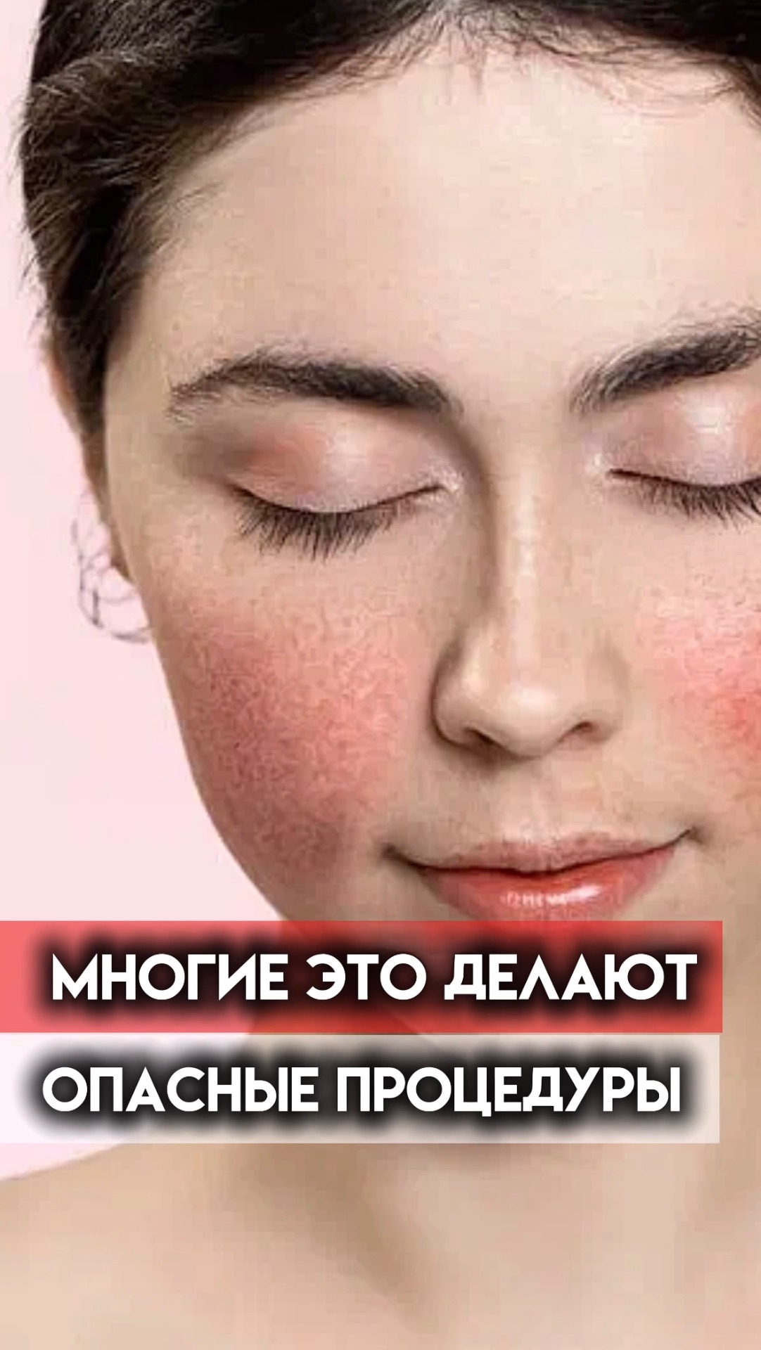 Никогда не делай так при розацеа! смотреть онлайн