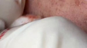 Выдавливание прыщей, угрей, черных точек и камедонов #79