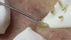 Relax Spa 033 • АСМР • Acne collection