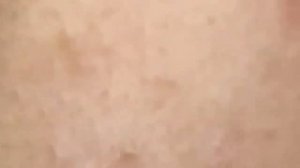 Выдавливание прыщей, угрей, черных точек и камедонов #83